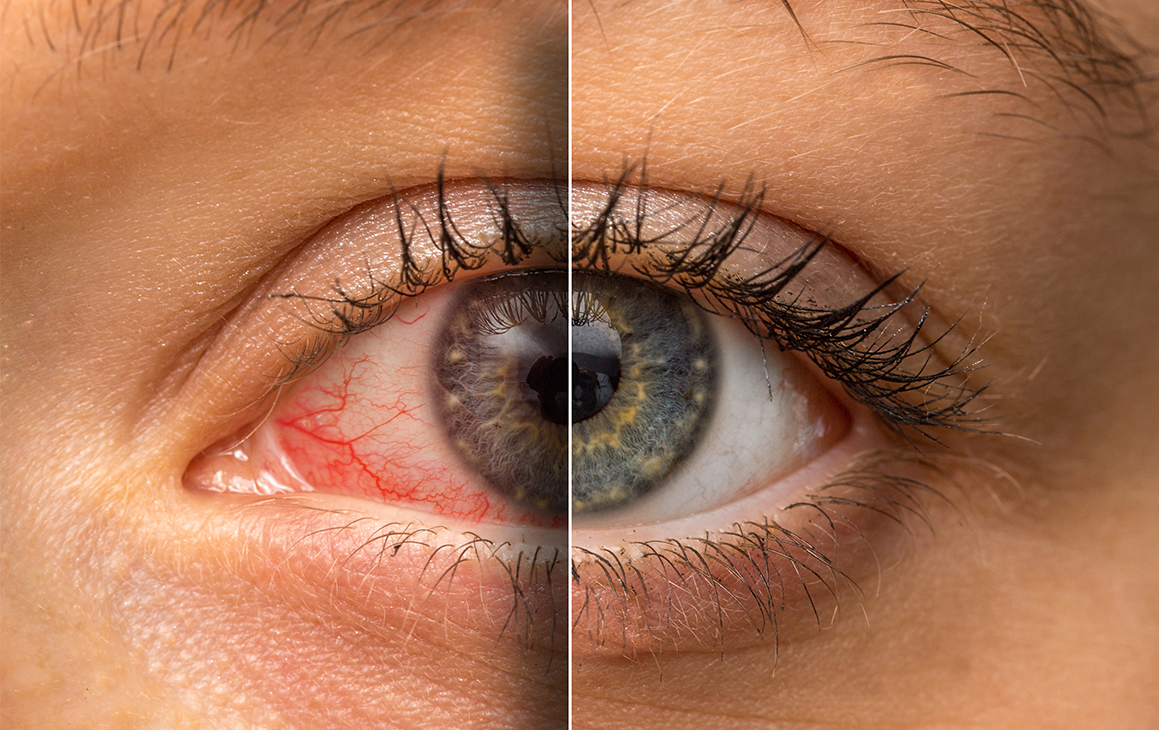 Impact de la conjonctivite allergique sur la santé oculaire et la vision